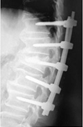 脊椎後方固定術